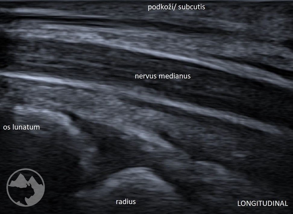 Sonografie periferních nervů v rehabilitaci